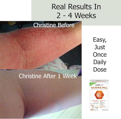 Eczema Pill – Natural Eczema Treatment – Dermatologist Developed – 7 All Natural Minerals Clear & Prevent Eczema Scaling, Rash, Itch, Inflamed Skin for Kids & Adults