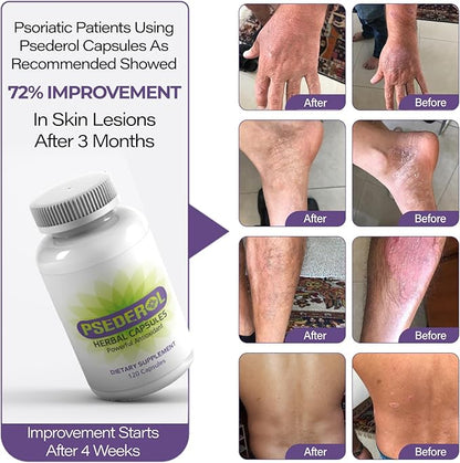 Psoriasis Support for Skin, 120 Herbal 6 Antioxidant