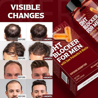 DHT Blocker for Men | Hair Growth Supplement with Saw Palmetto & Biotin - Hair Growth Vitamins - Hair Regrowth - Natural Hair Loss Supplements Liquid-Filled - Proprietary Herbal Blends (180 Capsules)